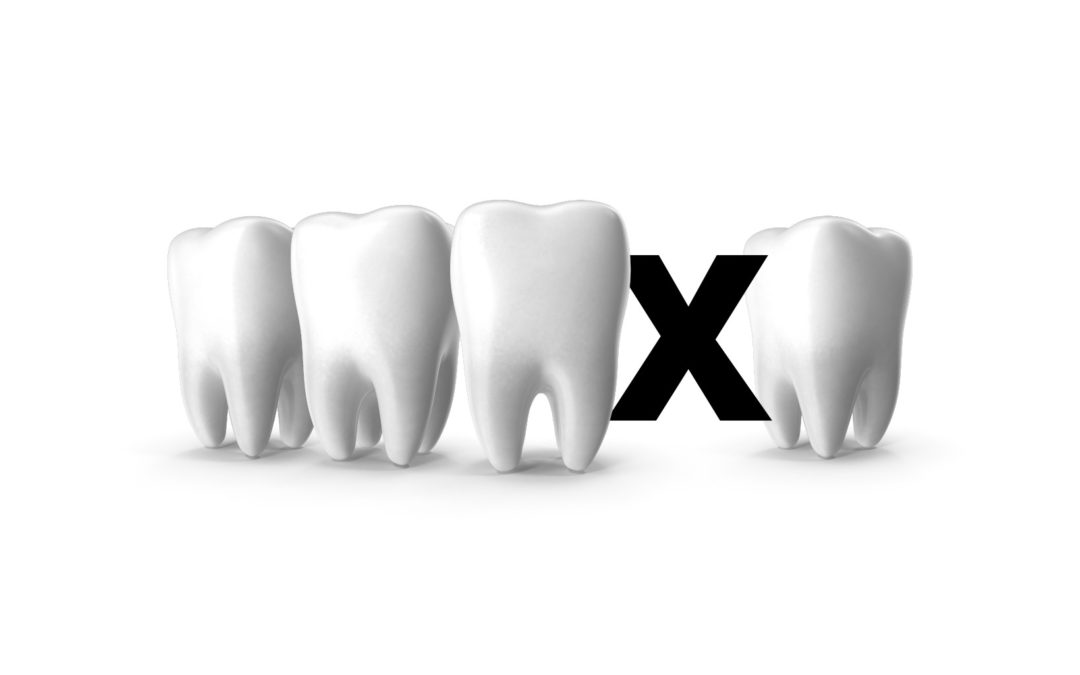 Utrata zęba – destrukcyjna luka?
