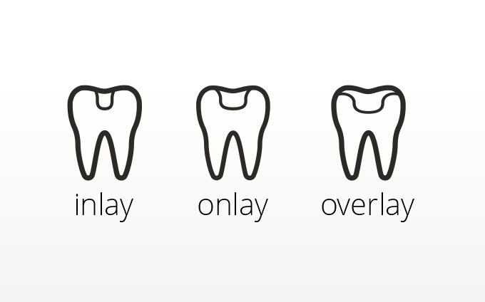 Jak odbudować złamany uszczerbany ząb?