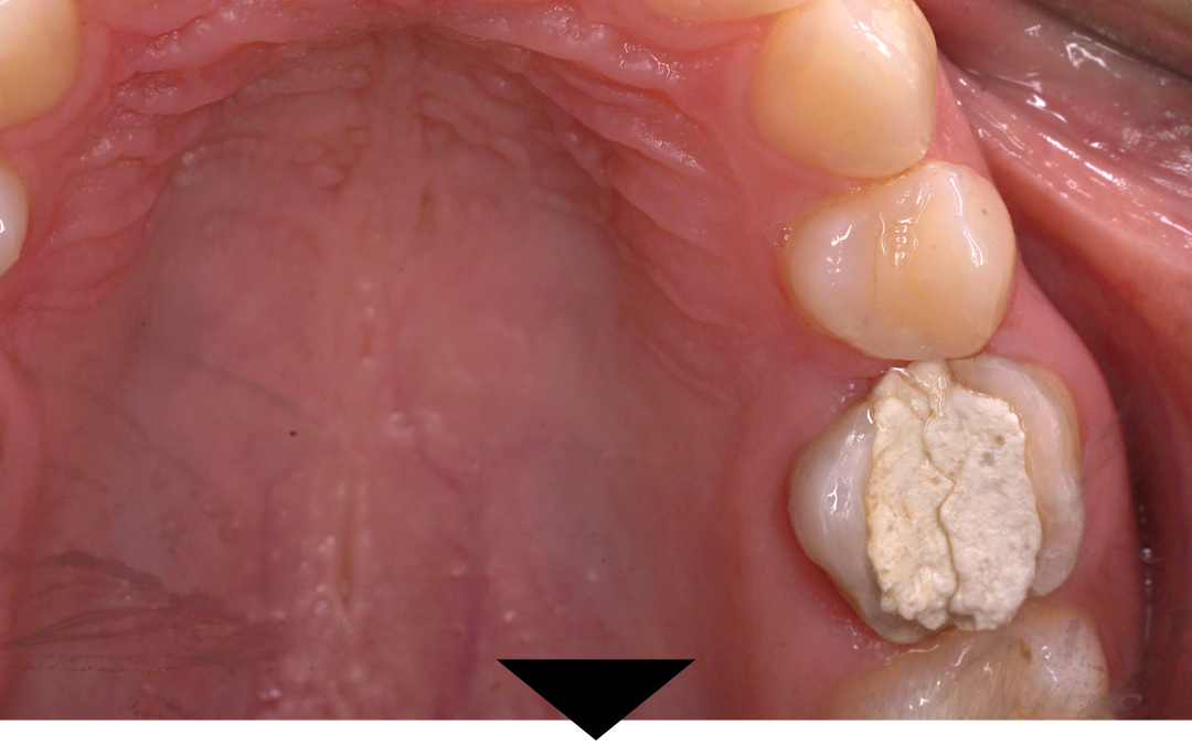 Złamany ząb natychmiastowa implantacja