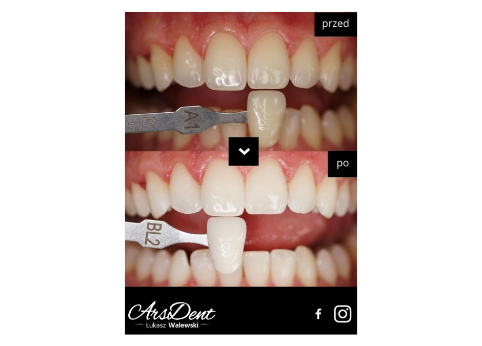 #Wybielanie zębów wykonane przez higienistkę Angelikę Przybylską