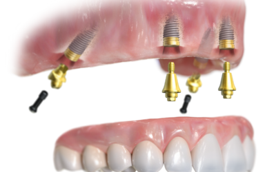 Czy wszczepienie implantu boli? Fakty, znieczulenie i okres po zabiegu